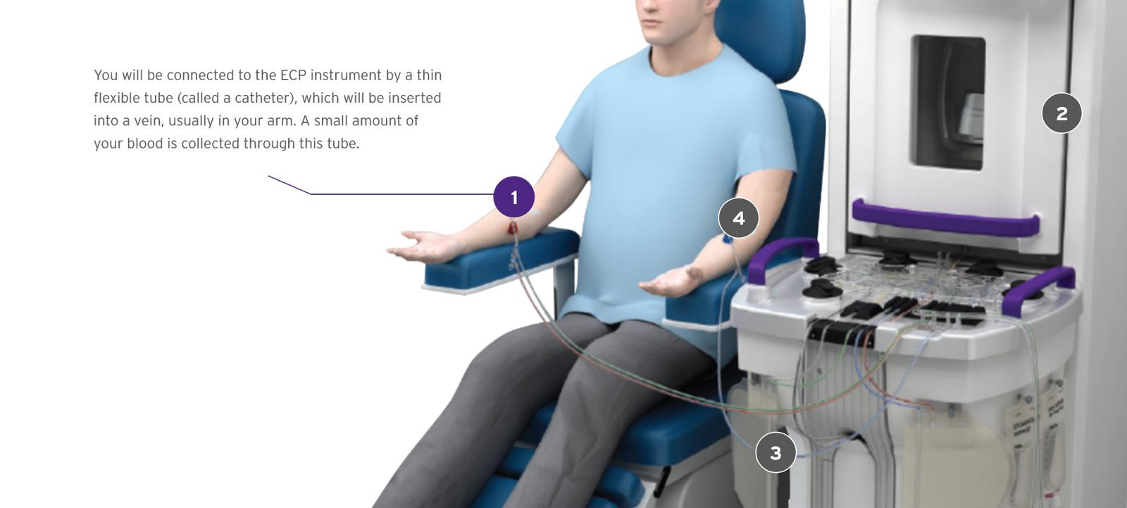 Label 1 of the diagram points to the catheter in the patient's left arm. You will be connected to the ECP instrument by a thin flexible tube (called a catheter), which will be inserted into a vein, usually in your arm. A small amount of your blood is collected through this tube.