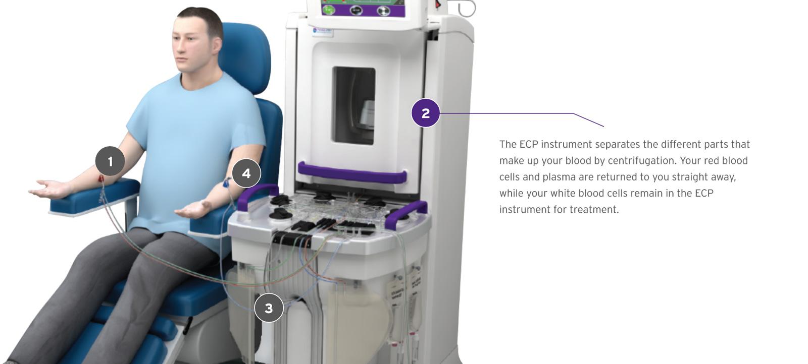 Label 2 of the diagram, which is pointing to the ECP instrument. The ECP instrument separates the different parts that make up your blood by centrifugation. Your red blood cells and plasma are returned to you straight away, while your white blood cells remain in the ECP instrument for treatment.